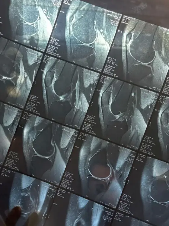 Resonancia magnética de rodilla para diagnóstico de la lesión